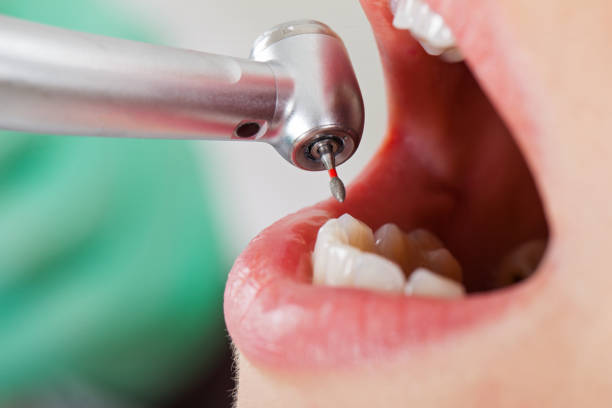 Best Emergency Dental Extractions in Blue Mound, IL